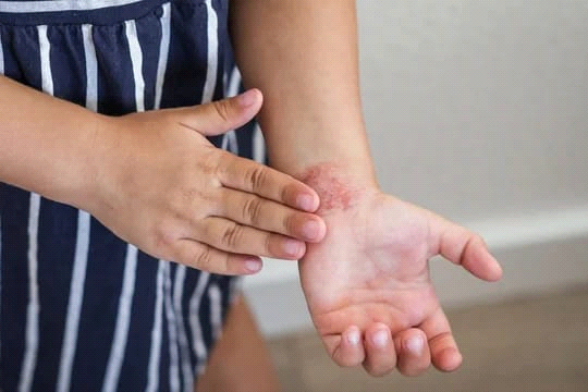 The Skin Barrier Matters—But It’s Only One Piece of the Puzzle