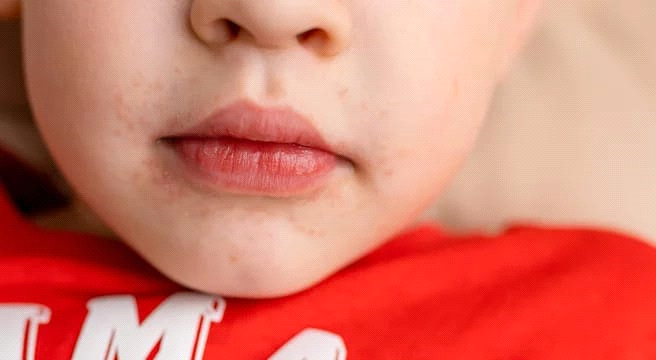 Is Baby Eczema Really Genetic? Here’s What the Science Actually Says