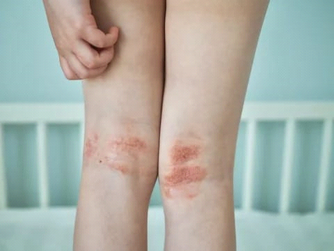 What Dry Skin Looks Like on the Outside – and What the Numbers Reveal Beneath the Surface
