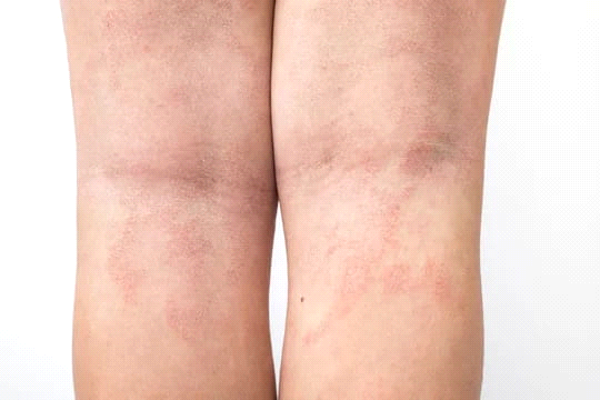 Dry Skin as an Early Warning Signal: What Happens Before the Rash Appears?