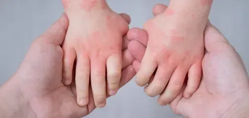 Parent and baby illustration for a guide explaining why babies may have itchy skin, scratching and eczema-prone skin