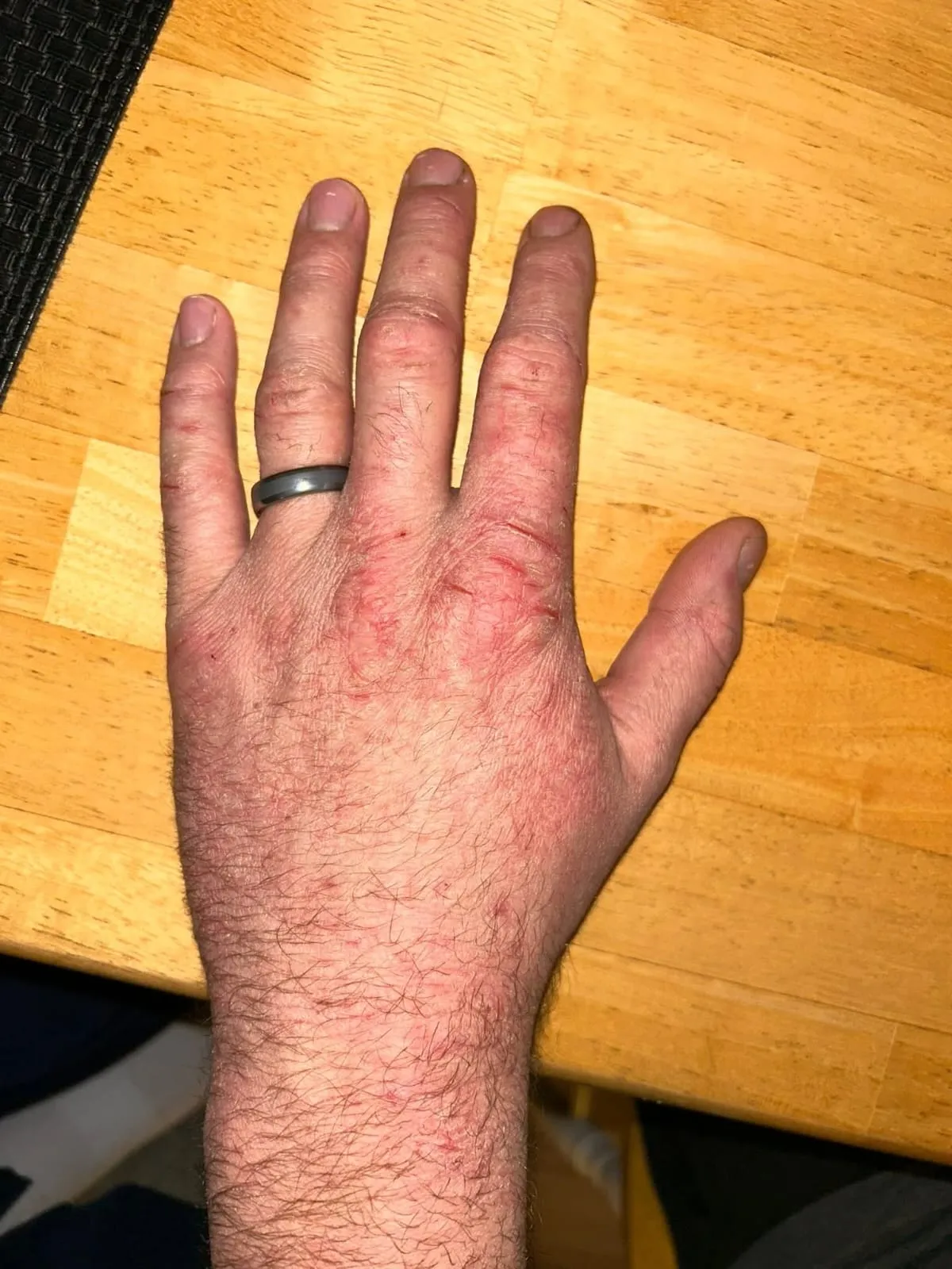 Baby with dry itchy eczema-prone skin for a parent guide about laundry detergent, clothing, sheets and residue