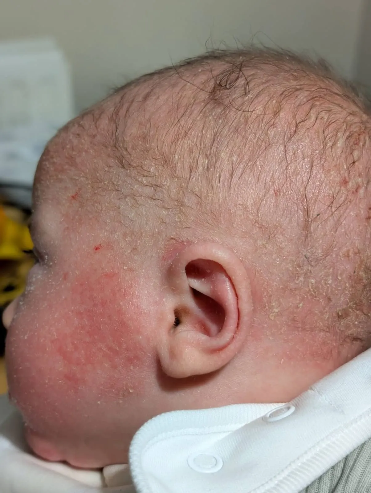 Baby with dry itchy eczema-prone skin for a parent guide about heat, sweat and scratching