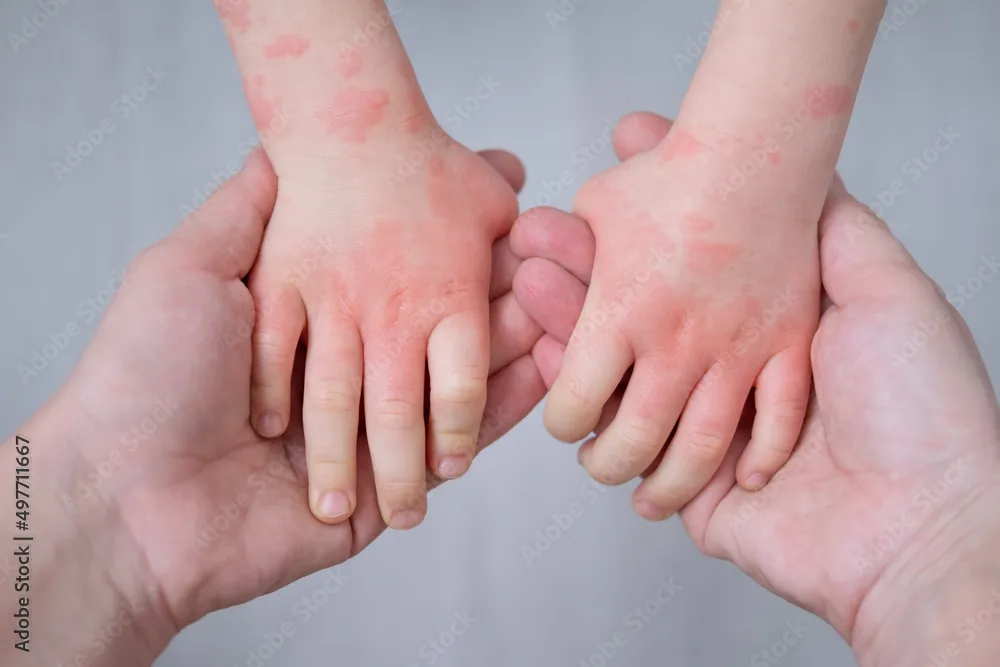 Baby with dry itchy eczema-prone skin for a parent guide about food allergy, food triggers and eczema itching