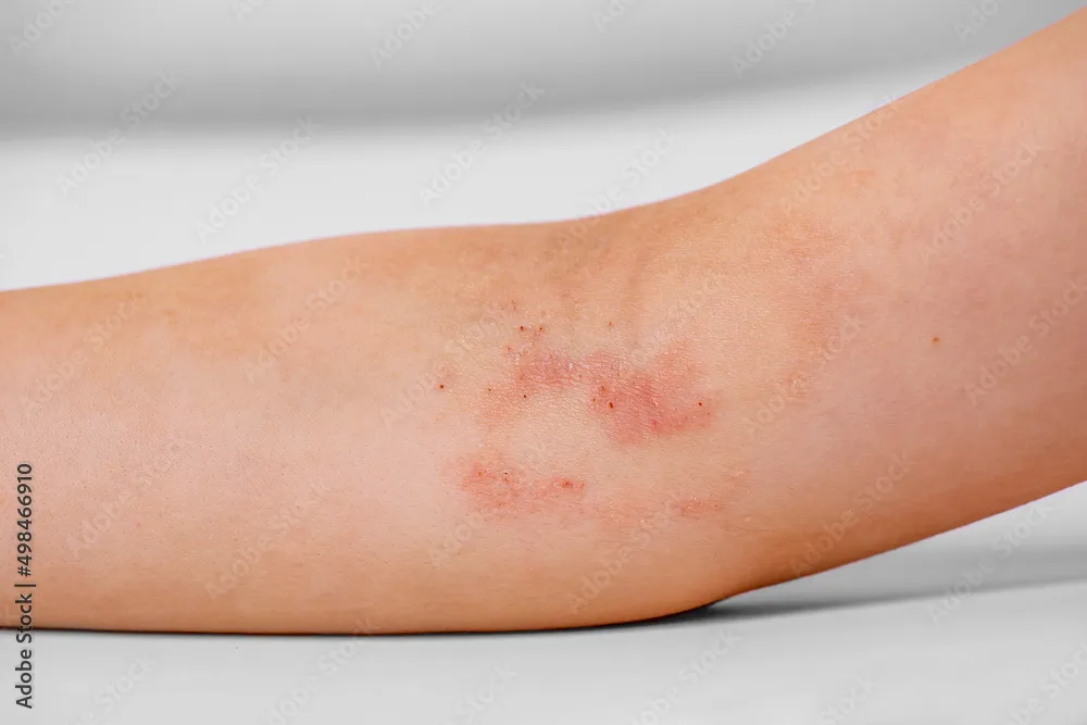 Baby with eczema-prone skin for a parent guide about itching and eczema returning after steroid cream treatment
