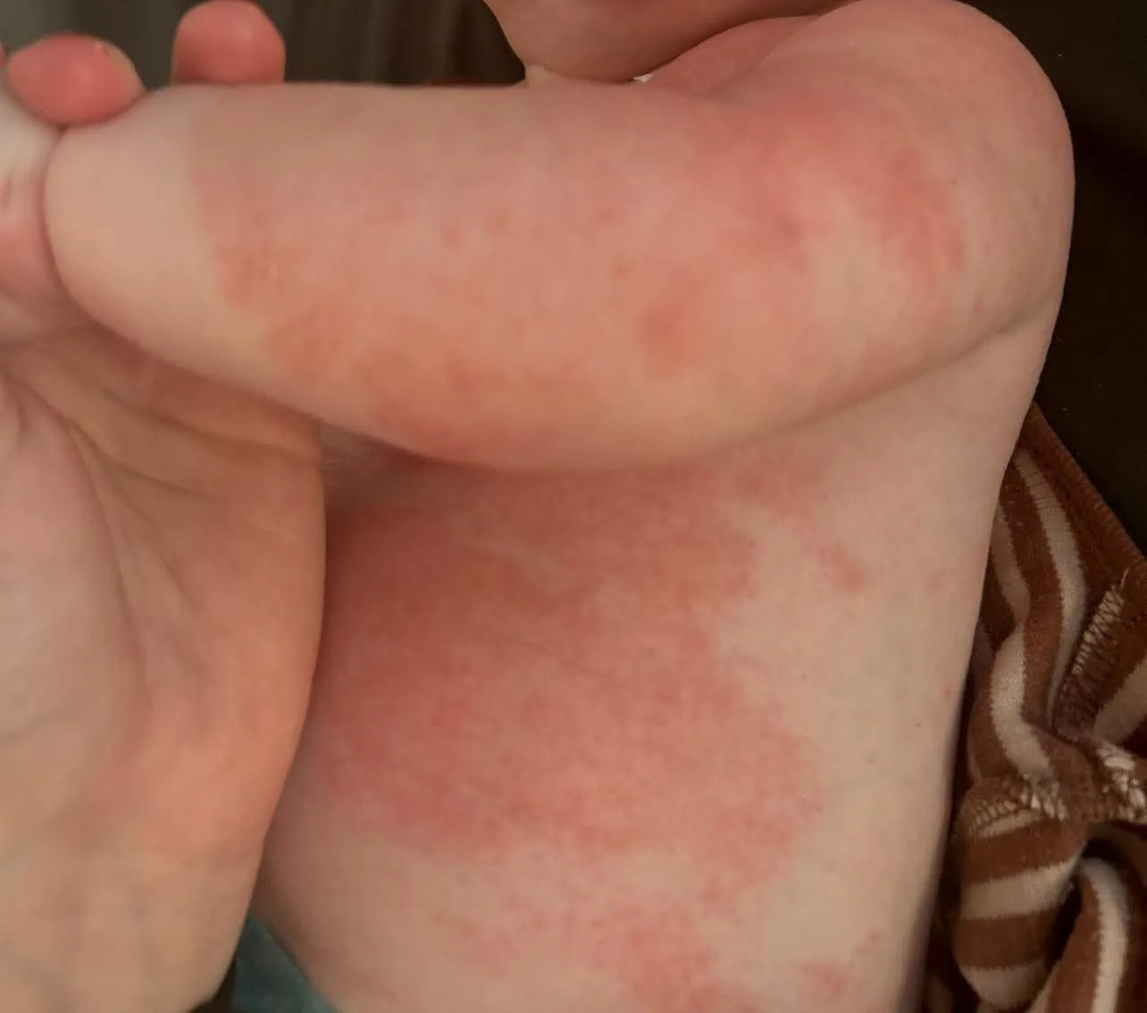 Baby with dry itchy eczema-prone skin for a parent guide about itching after bath time and common bathing mistakes