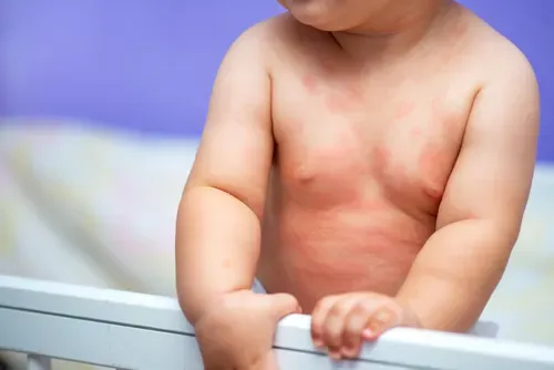 Moisturising baby eczema-prone skin for a guide about persistent itching and scratching after using cream