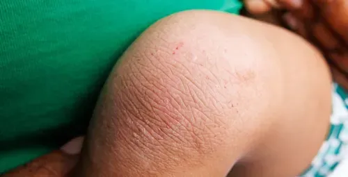 Baby with sensitive skin for a parent guide about itch relief cream for babies and the Repair, Nourish and Defend approach