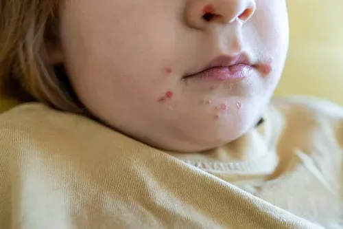Baby with dry irritated skin for a parent guide about choosing the best cream for itchy, sensitive and eczema-prone baby skin