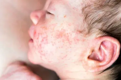 Baby with irritated skin for a parent guide about constant scratching, dry skin and eczema-prone skin
