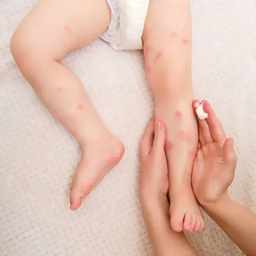 Mother caring for toddler skin for an article about baby eczema that looks better while itching and scratching continue